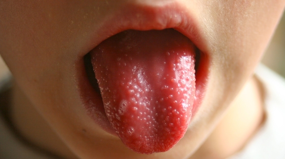 Скарлатина