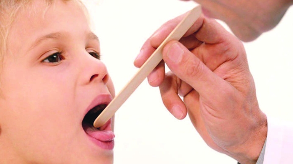 Хронический тонзиллит