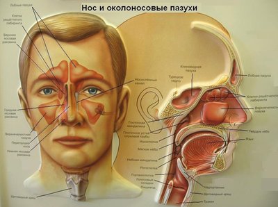 Острые синуситы